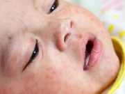 Спасибо советской медицине: мир болеет корью — Россия успешно противостоит эпидемии Спасибо советской медицине: мир болеет корью — Россия успешно противостоит эпидемии